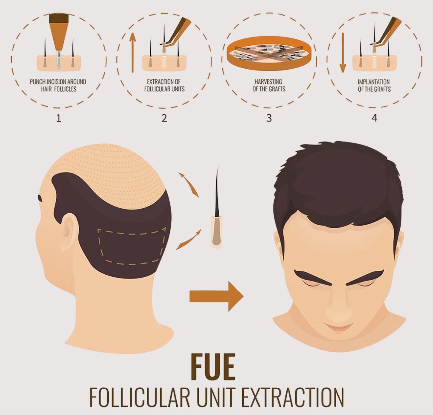 Norwood Scale for male pattern baldness
